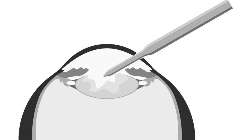 Katarakt-Operation - Schritt 1