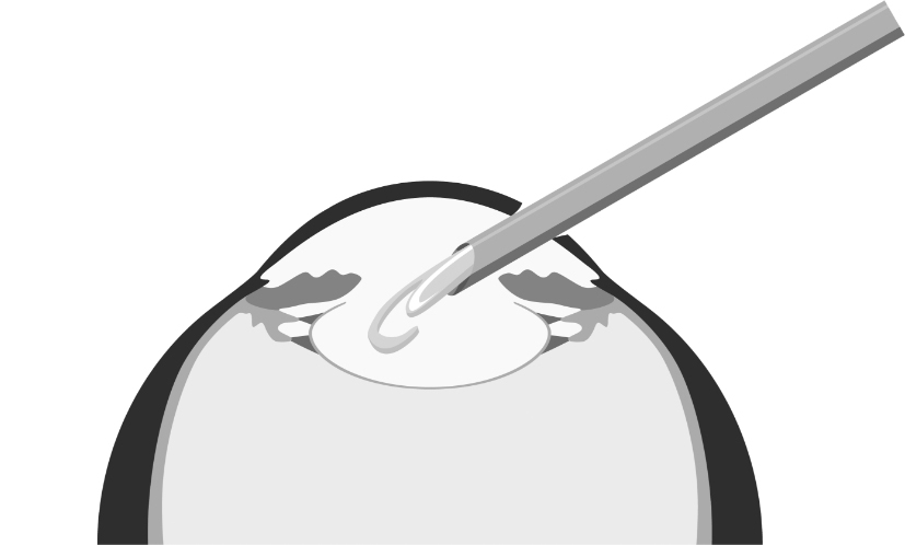 Katarakt-Operation - Schritt 2