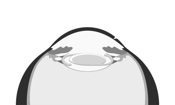 Katarakt-Operation - Schritt 3